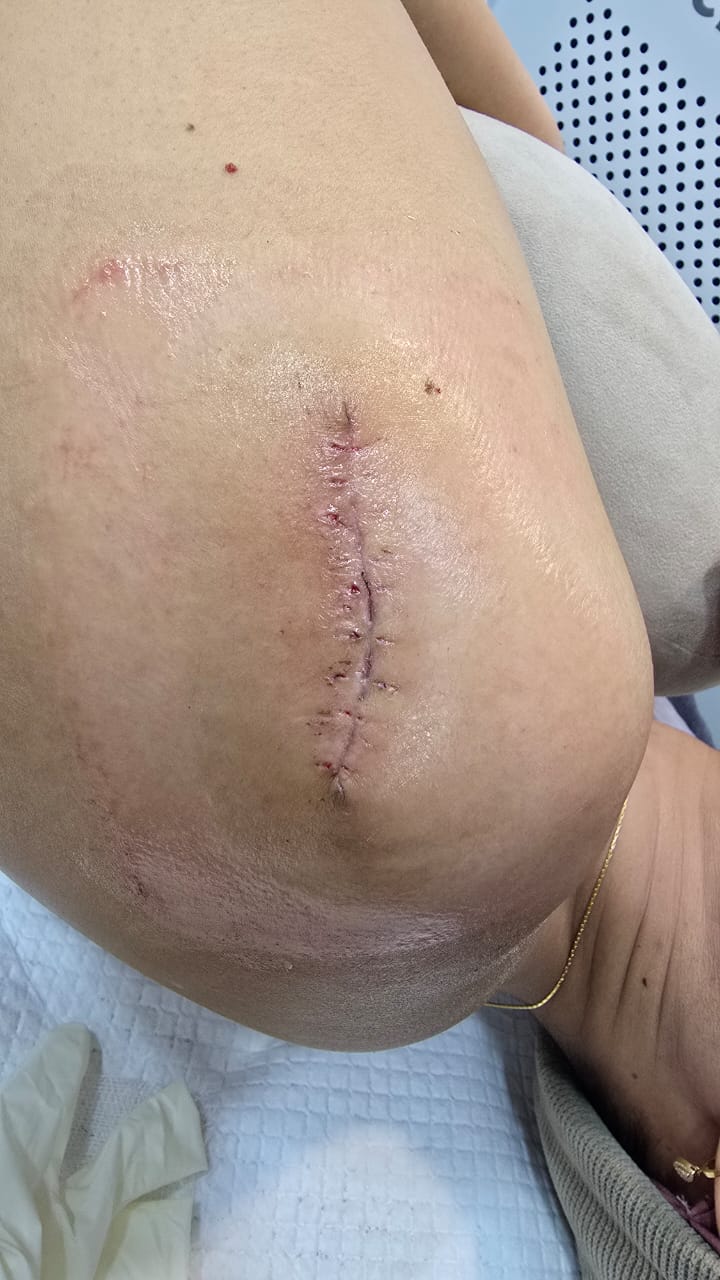 Bowen disease healing progress